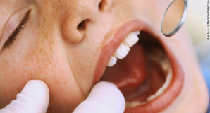 Composite Fillings